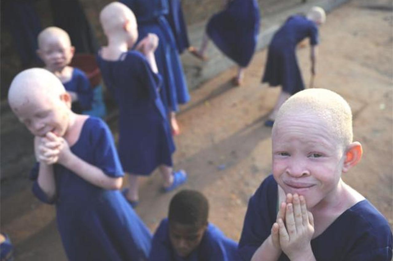 albino, tanzanija