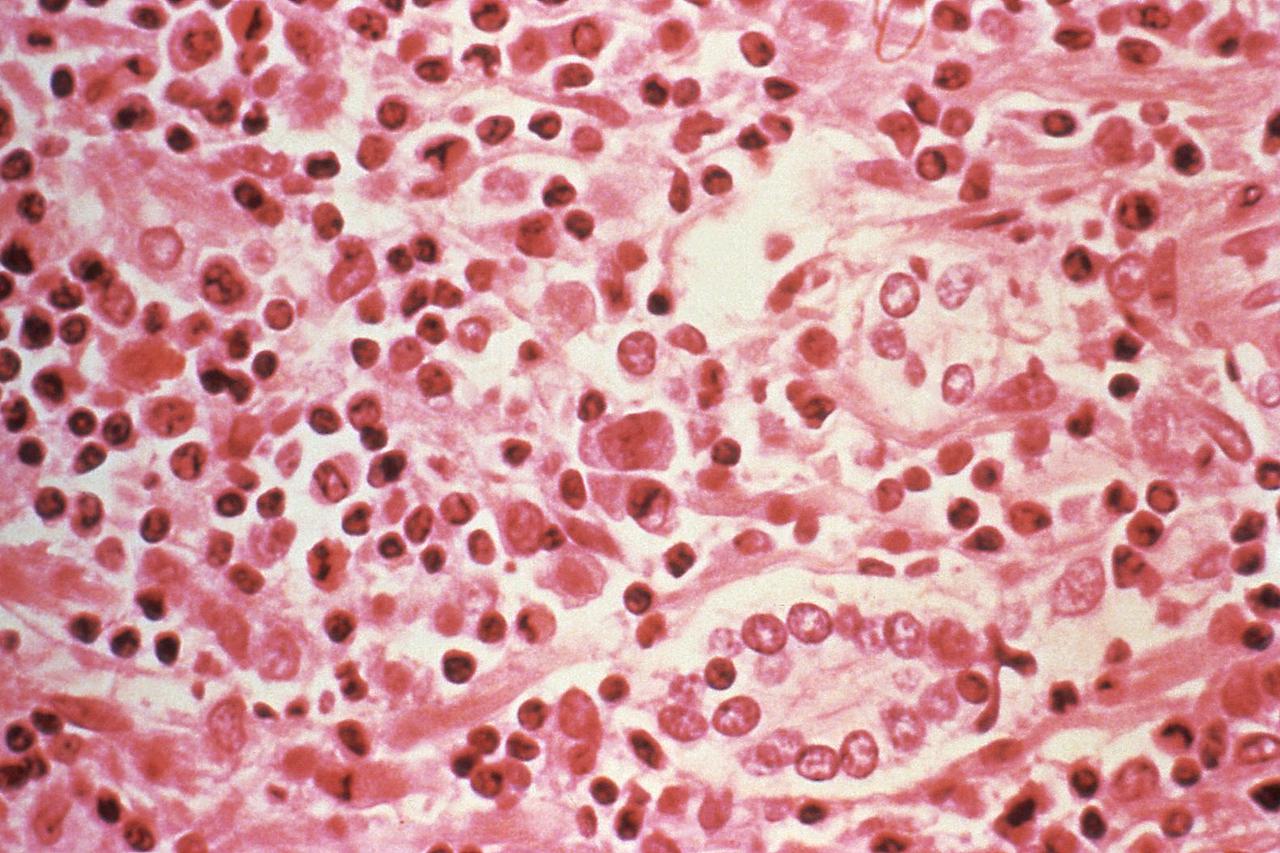 FILE PHOTO: A micrographic study of liver tissue seen from a Hantavirus pulmonary syndrome (HPS) patient